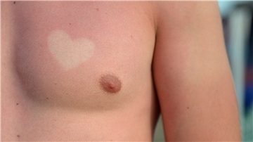 Bei der Kraft der Sonne und ihrer UV-Strahlung sollte man einen ausreichenden Sonnenschutz nicht vergessen. Denn ein Sonnenbrand kann schmerzhaft sein und erhöht das Risiko an Hautkrebs zu erkranken.