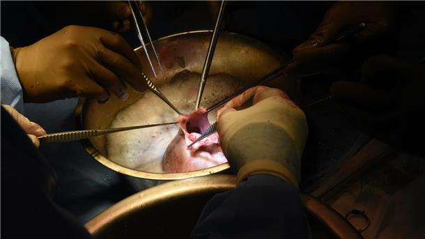 Chirurgen führen die Transplantation des Schweineherzens im Krankenhaus in Baltimore durch.