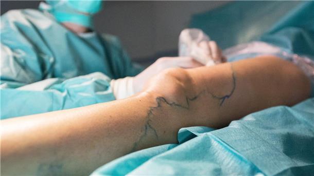 Ein Patient mit Krampfadern liegt auf einem OP-Tisch, während ein Operateur an ihm arbeitet. 
