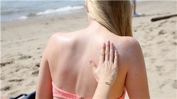 „Das Risiko, einen Sonnenbrand zu bekommen, ist abhängig vom Sonnenstand und in den Sommermonaten von Juni bis August sowie in der Mittagszeit zwischen 11 und 15 Uhr besonders hoch“, sagte der Dermatologe Mark Berneburg der Deutschen Presse-Agentur.