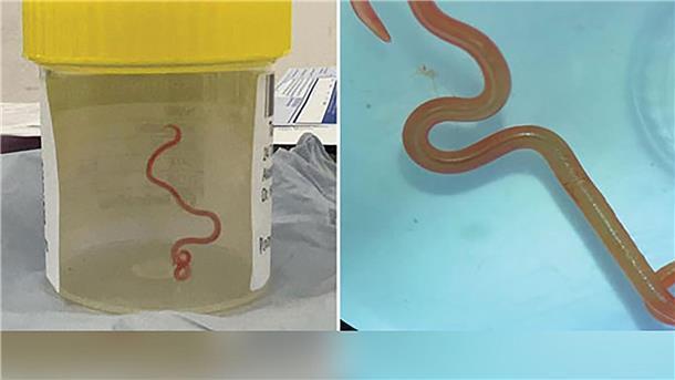 „Lebendig und zappelnd“: Wurm in Gehirn von Australierin Der lebende Spulwurm „Ophidascaris robertsi“ wurde im Gehirn einer 64-jährigen Australierin gefunden.
