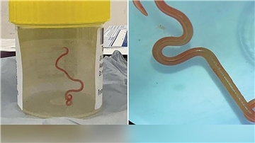 Der lebende Spulwurm „Ophidascaris robertsi“ wurde im Gehirn einer 64-jährigen Australierin gefunden.