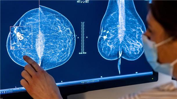 Medizinisches Personal untersucht mit einer Mammografie die Brust einer Frau auf Brustkrebs.