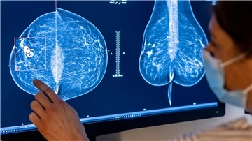 Medizinisches Personal untersucht mit einer Mammografie die Brust einer Frau auf Brustkrebs.