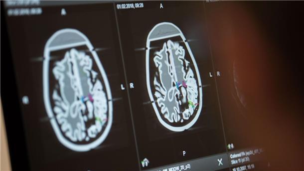 Keine nachweisbaren Hirnschäden nach Havanna-Syndrom Die Fallzahlen für Erkrankungen des Nervensystems sind weltweit deutlich gestiegen.