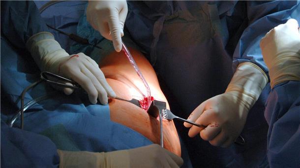 Die meisten Anträge von Patienten im Land Bremen, die einen Behandlungsfehler vermuten und sich an die Schlichtungsstelle wenden, kommen aus den Fachgebieten Orthopädie und Unfallchirurgie, sonstiger Chirurgie sowie der Inneren Medizin. 