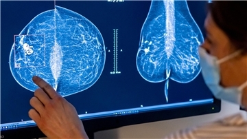 Die Möglichkeiten zur Mammographie für die Früherkennung von Brustkrebs soll ausgeweitet werden.