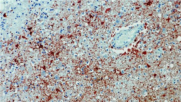 Die undatierte Aufnahme zeigt einen Anitkörpernachweis zum Borna-Virus im Gewebe.