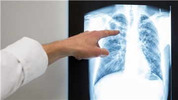 Die Weltgemeinschaft ist nicht auf Kurs, ihre selbstgesteckten Ziele zur Eindämmung der Tuberkulose zu erreichen.
