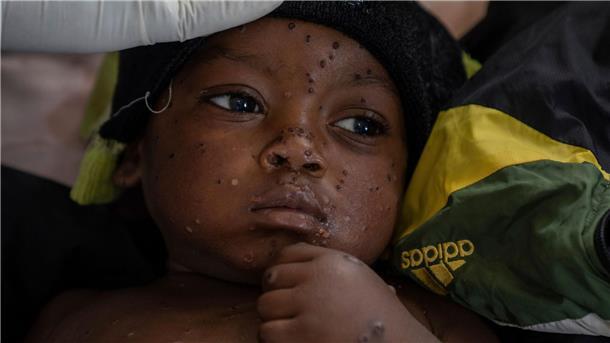 Ein an Mpox erkrankter zweijähriger Junge liegt in einem Krankenhaus in Kamituga im Osten des Kongo.