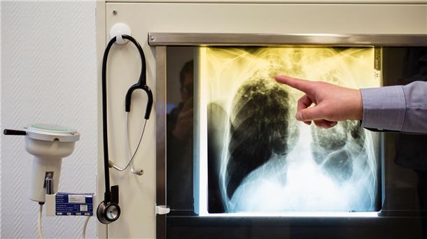 Ein Arzt zeigt einen Tuberkulose-Fall anhand eines Röntgenbildes im Tuberkulosezentrum in Berlin.