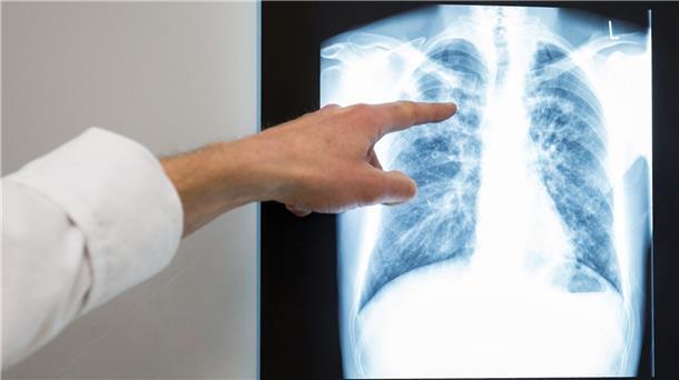 Etwas mehr Tuberkulose-Fälle in Niedersachsen Ein Arzt zeigt im Vivantes Klinikum Neukölln auf das Röntgenbild einer Lunge.