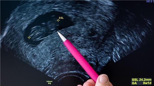 Mit einem Stift zeigt jemand auf das Bild eines Fötus. 