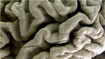 Eine Nahaufnahme eines menschlichen Gehirns, das von der Alzheimer-Krankheit betroffen ist, ausgestellt im Museum für Neuroanatomie an der University at Buffalo.