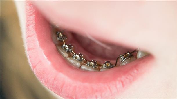 Eine Zahnspange muss nicht unbedingt auffallen. Eine Möglichkeit ist eine feste Spange, bei der die Brackets von innen auf den Zahn geklebt werden.