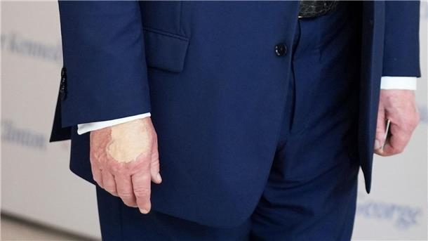 Für Trump ein unliebsames Thema: die überschminkte Hand (Archivbild).