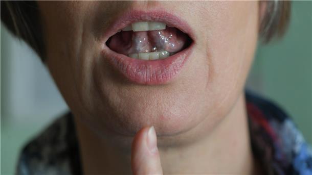 In einer Logopädischen Praxis wird bei einer Stotter-Therapie mit dem Mund und der Zunge der Laut „L“ geformt. Bestimmte Übungen können Stotterern helfen.