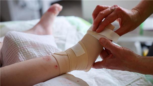 Verletzlich wie ein Schmetterling: Hoffnung auf Gentherapie Käthe unterzieht sich dem täglichen, zweistündigen Verbandswechsel. Die Vierjährige leidet an Epidermolysis bullosa.