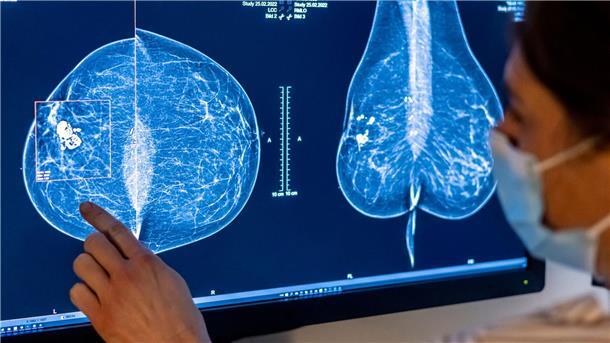 Mammografie in einer Klinik in Berlin. Frauen sind nicht nur von Brustkrebs betroffen, sondern häufig auch von Gebärmutter-, Lungen- und Darmkrebs.