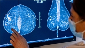 Mammografie in einer Klinik in Berlin. Frauen sind nicht nur von Brustkrebs betroffen, sondern häufig auch von Gebärmutter-, Lungen- und Darmkrebs.