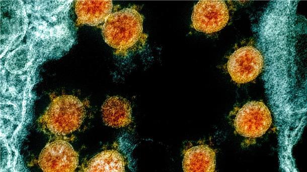 WHO beobachtet Coronavirusvariante XBB.1.16 Partikel des Coronavirus SARS-CoV-2 wurden für eine elektronenmikroskopische Aufnahme am „National Institute of Allergy and Infectious Diseases Integrated Research Facility“ farblich bearbeitet.